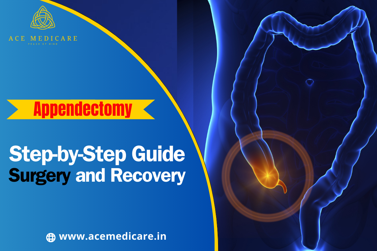 A Step-by-Step Guide to Appendectomy Surgery and Recovery